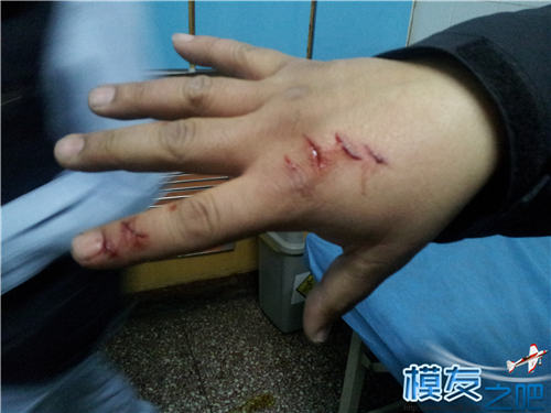 玩模型需谨慎！血的教训！（外伤处置视频晕血者慎入。... 模型,晕血的人多吗,外伤怎么处理,晕血后怎么办 作者:飞天狼 1371 
